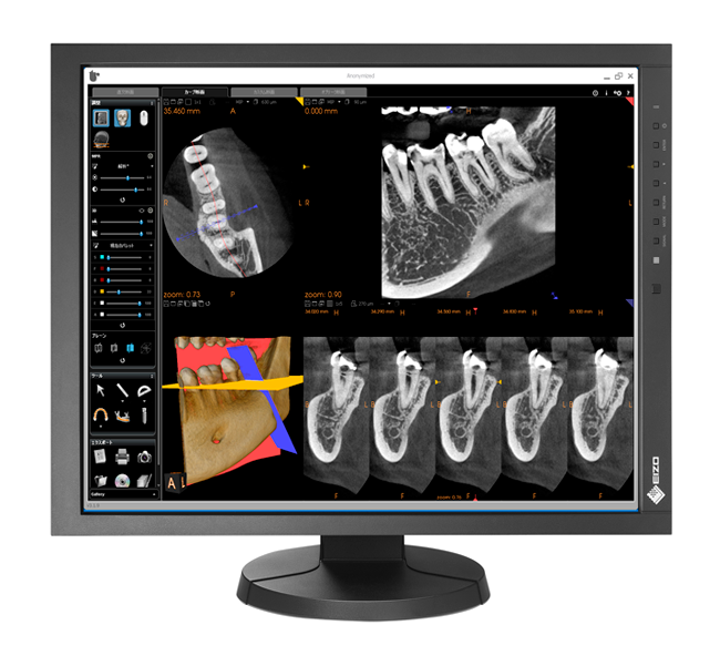 Màn hình phòng mổ tại Bệnh viện Đại học Wales/ Anh 1 màn hình phòng mổ EIZO RadiForceMX215_First-Image