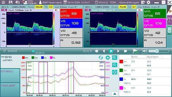 ATYS - Thương hiệu hàng đầu về máy Doppler xuyên sọ và Doppler mạch máu